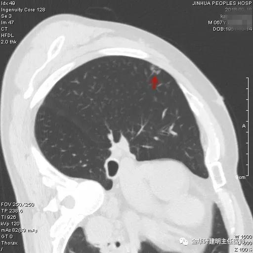 肺多发转移癌主要治疗手段,右肺上叶癌怎么治疗