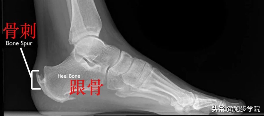 跑步怎样预防跟腱炎,预防跟腱炎最好的方法