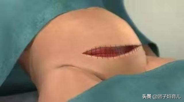 剖腹产生娃也能改善体质吗,剖腹产半麻醉生孩子的真实流程