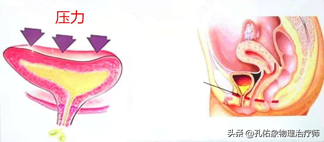 女性漏尿很严重是什么原因造成的,女性漏尿的原因及解决办法