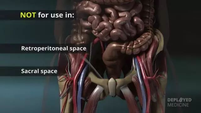 突破传统止血局限：美军战场止血利器X-stat
