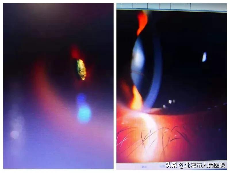 异物入眼划伤眼睛,眼睛进金属异物会失明么