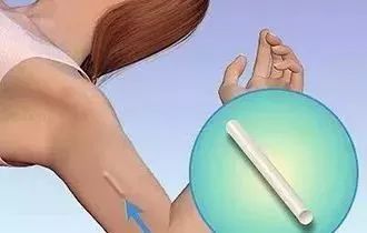 小小一根棒，比套套和上环安全，避孕率超高却少有人知道...