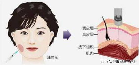 有的瘦脸针打了脸会酸有的没感觉,打完除皱针脸部看上去很奇怪