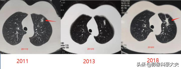 22岁查出癌症放弃治疗,医生自述得癌症放弃治疗