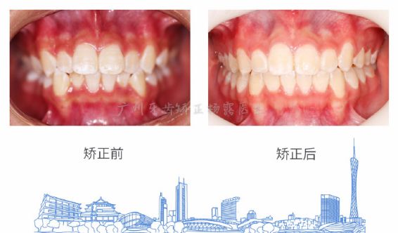广州牙齿矫正杨露隐适美隐形矫正戴牙套全案例