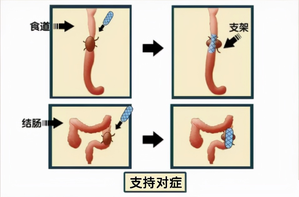 肿瘤介入微创疗法要多少钱,微创治疗肿瘤有哪些手段