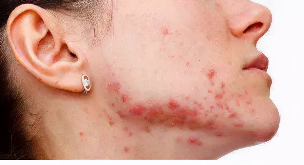 脸上长痘的几种原因,脸上长痘的三种原因