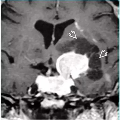 各种囊肿的症状,颅内囊肿18-19mm严重吗