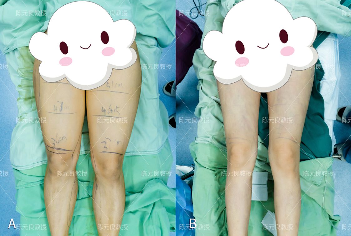 去做吸脂手术都咋想的,想抽脂需要了解的事项