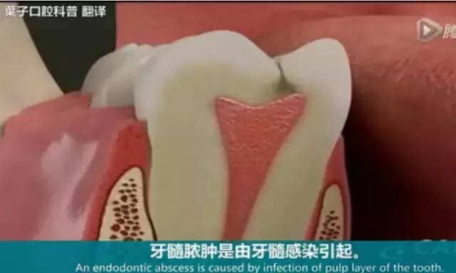 牙龈反复鼓包流脓是牙齿坏了吗,一上火牙龈就鼓包