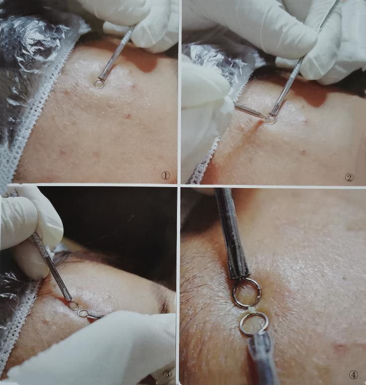 战“痘”系列之三：轻度*疮痤**的治疗