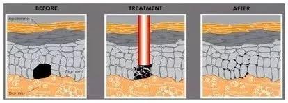 只需3步淡化斑点,简单4招快速淡化色斑