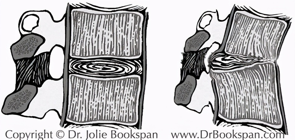 腰疼屁股疼是什么病,腰疼屁股疼是该吃什么药