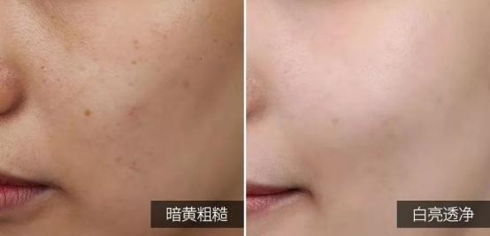 国际上有根除遗传雀斑的方法吗,专业祛斑四天根除遗传性雀斑