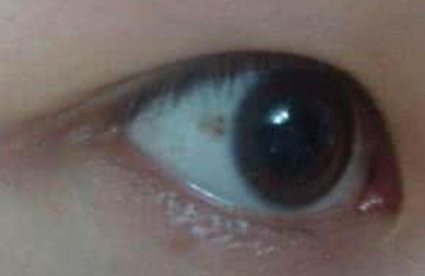 孩子眼白有小黑点是不好的表现吗,孩子眼白有青点是怎么回事