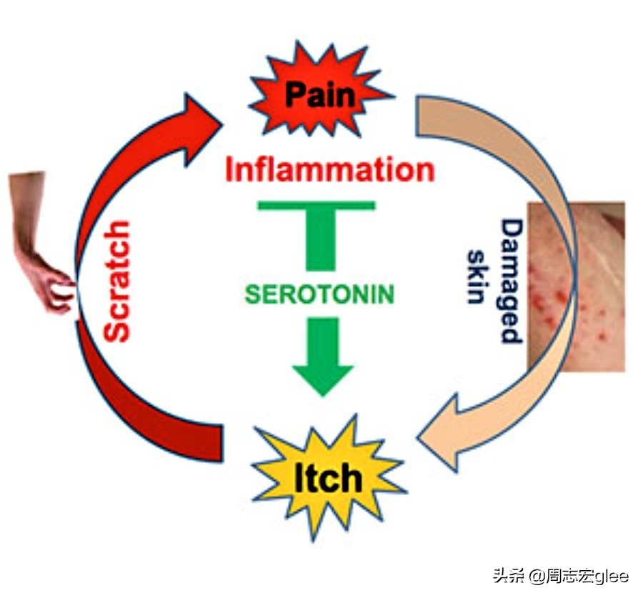 蚊虫叮咬一直痒怎样治,蚊虫叮咬越挠越痒怎么办