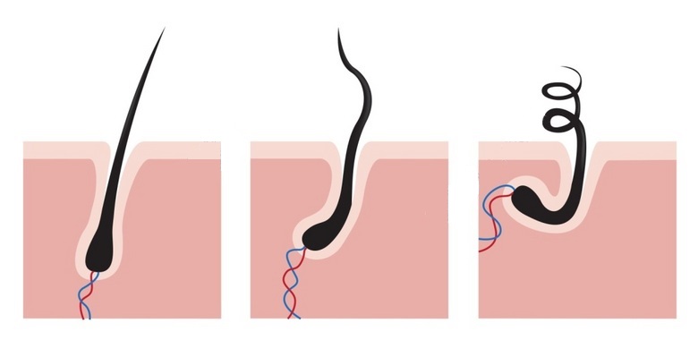 头发稀疏是毛囊坏死还是毛囊萎缩,毛囊萎缩还能长出头发吗