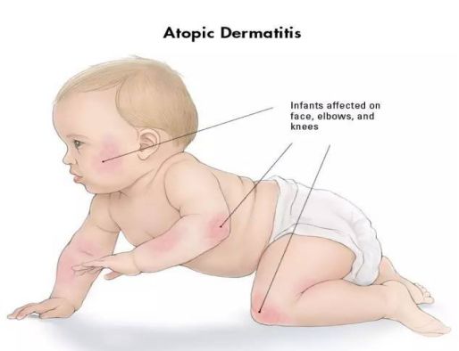 普及!宝宝湿疹不敢用药怕激素?湿疹护理指南来帮你