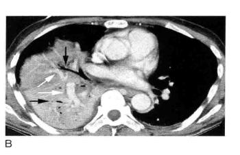 肺实变和肺炎的影像学区别,肺实变图