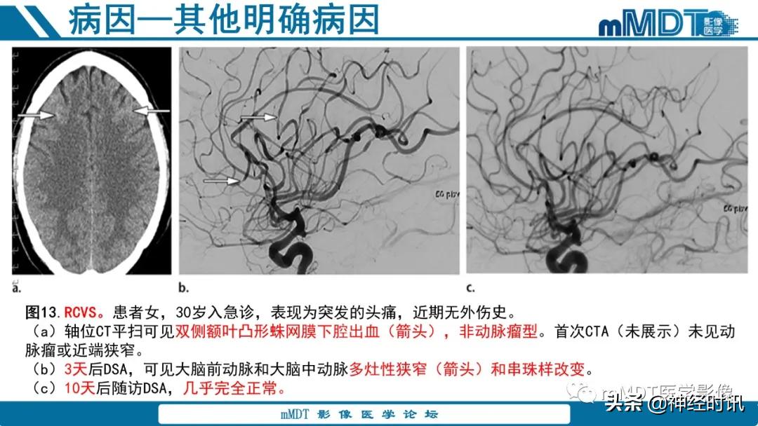 急性缺血性脑卒中ppt素材图片,青年缺血性脑卒中ppt