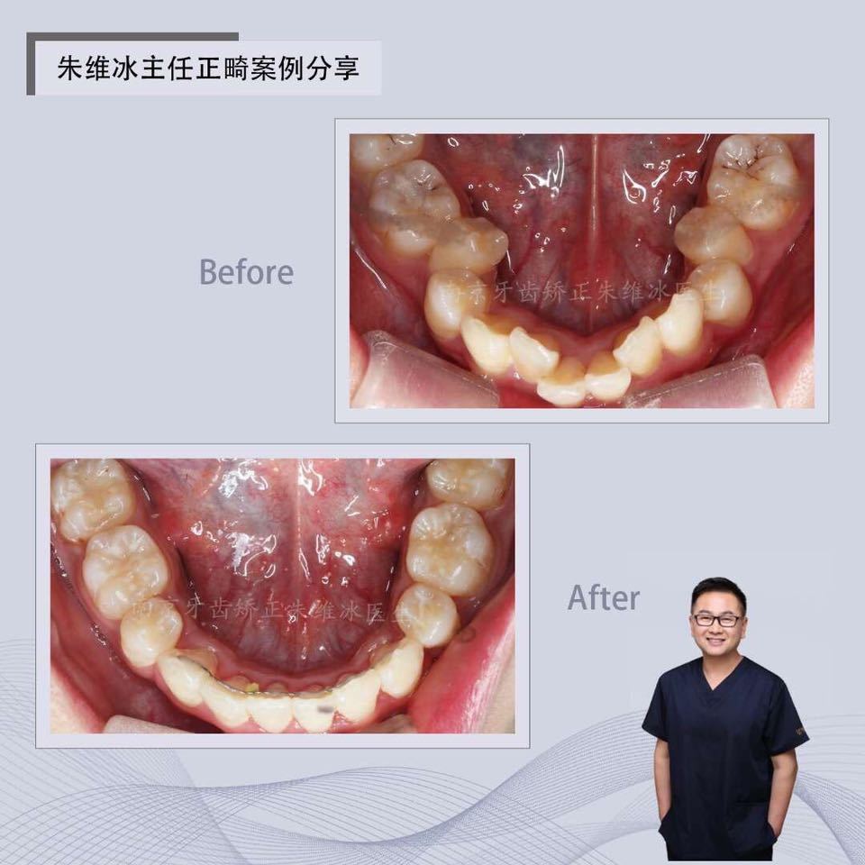 南京正畸朱维冰怎么样,南京牙齿正畸矫正技术