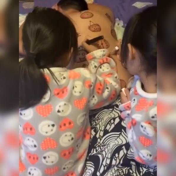 爸爸拔火罐后续,爸爸拔火罐后背留下印记