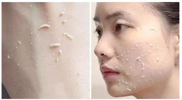 痘印很顽固怎么祛痘印,痘印祛痘药膏