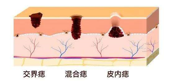 色素痣为什么都建议去除,为什么色素痣会越来越多