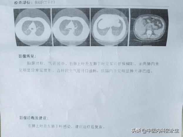 秦先生喝中药后，肺结节消失不见，一位肺结节患者的看诊历程