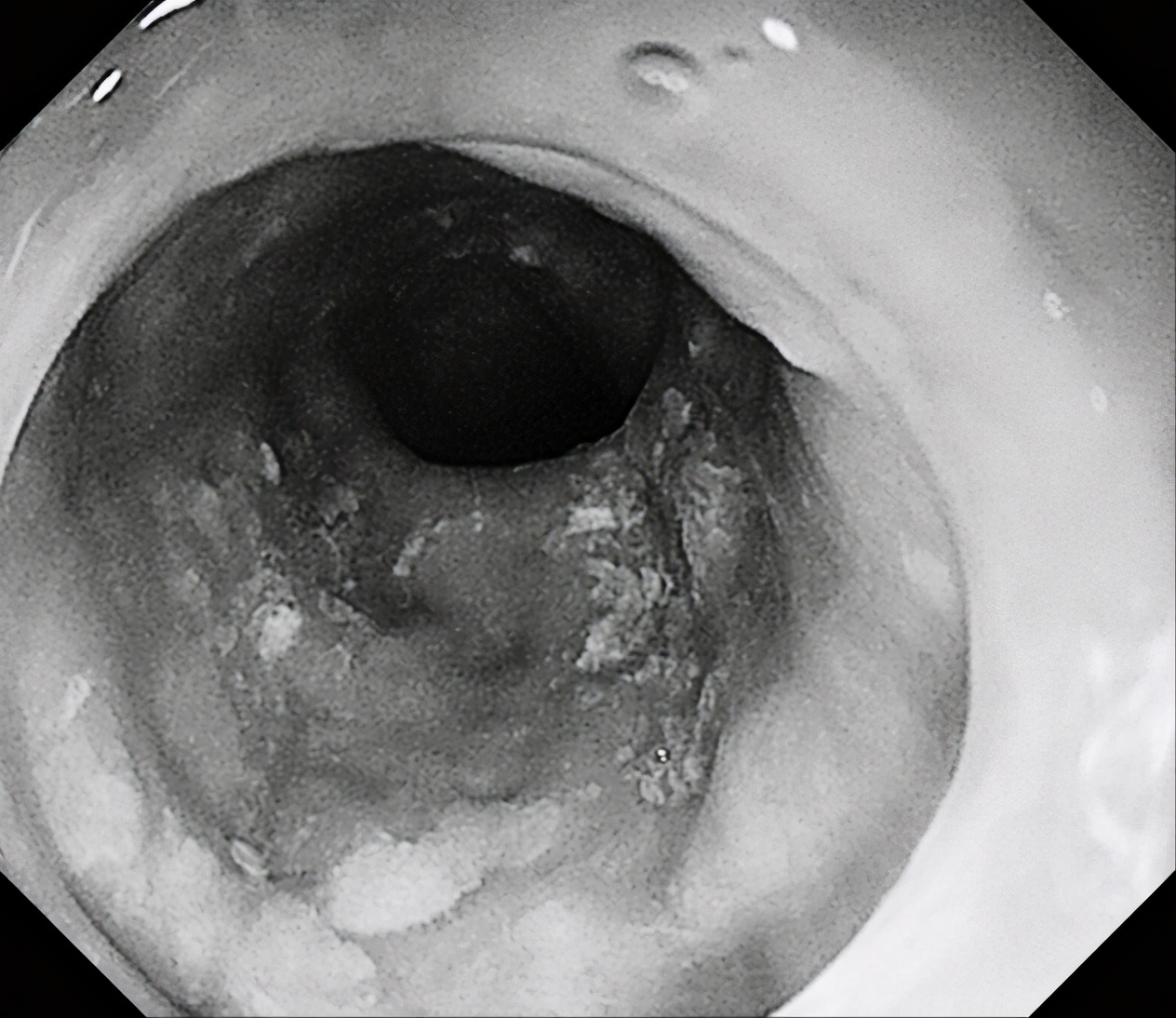胃镜下黏膜剥离手术护理,内镜黏膜下肿瘤剥离术