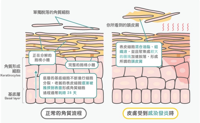 头皮屑最简单的解决方法,头皮屑的原因及解决方法