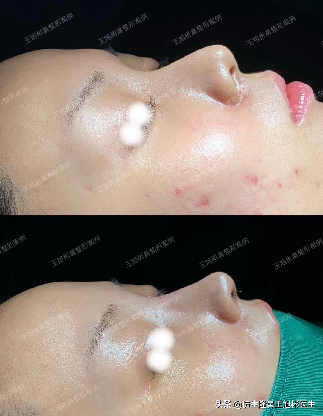 整形鼻部科普知识,隆鼻整形科普知识