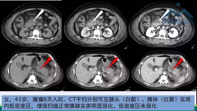 急性胰腺炎的护理措施,急性胰腺炎影像与临床