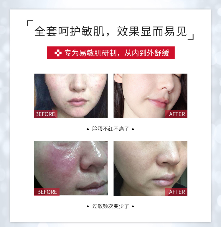 怎样修复红血丝最有效,皮肤有血丝有点红怎么修复