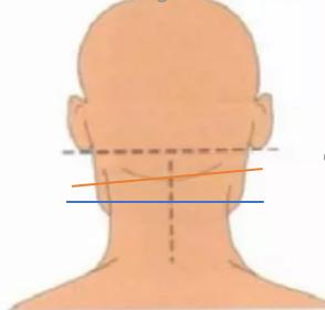 脊柱弯了怎么纠正视频,脊柱侧弯属于严重脊柱问题