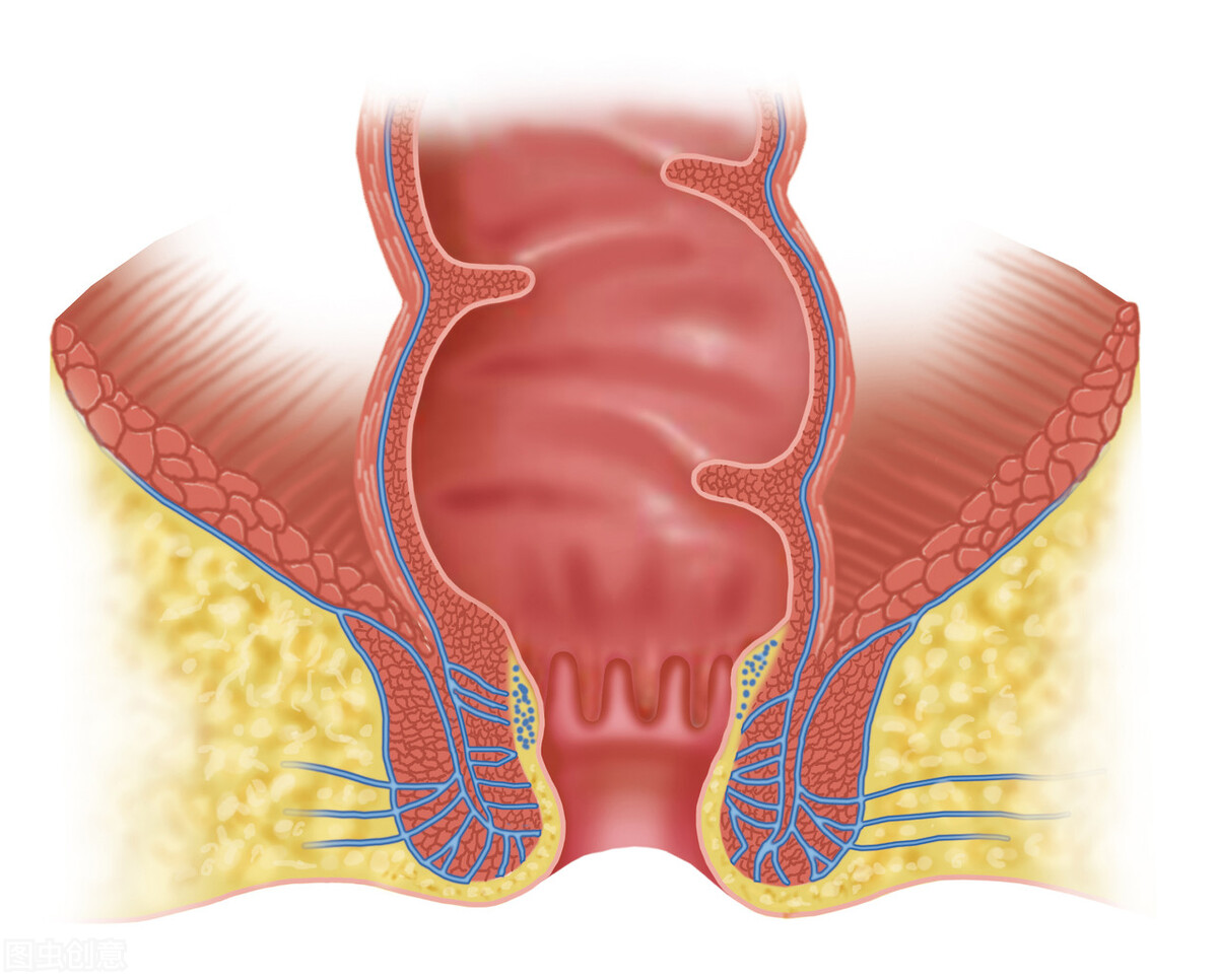 肛周脓肿为什么那么痛,肛周脓肿手术后大便撕裂疼
