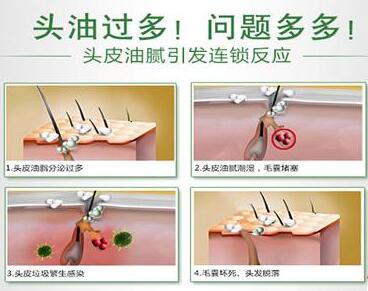 为什么年纪轻轻就脱发?第2个原因最关键!中西医治疗怎么来结合