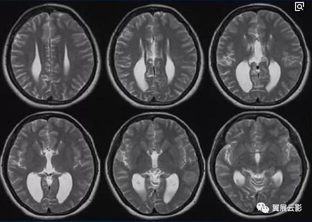 脑部脓肿怎么治疗,多发性脑脓肿能自愈吗