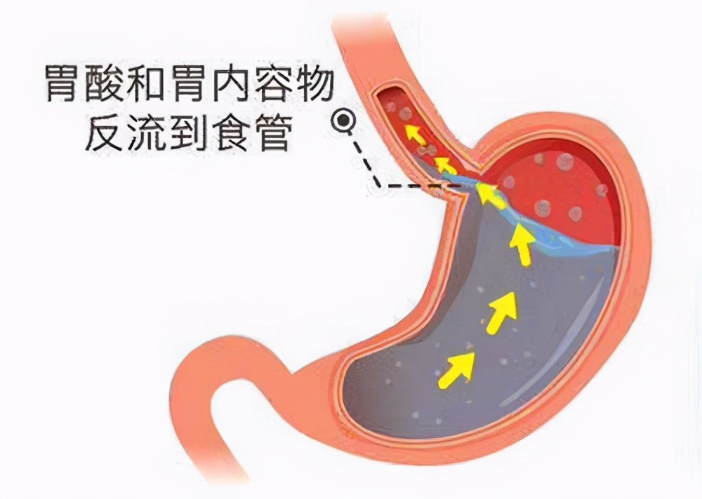 反流性食管炎要怎样预防,如何预防反流性食管炎