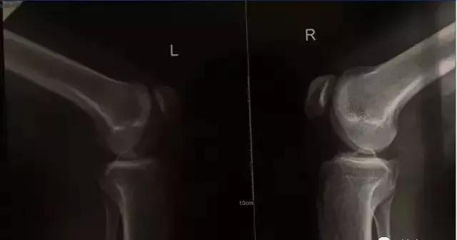 训练完关节响,训练时关节为什么会响