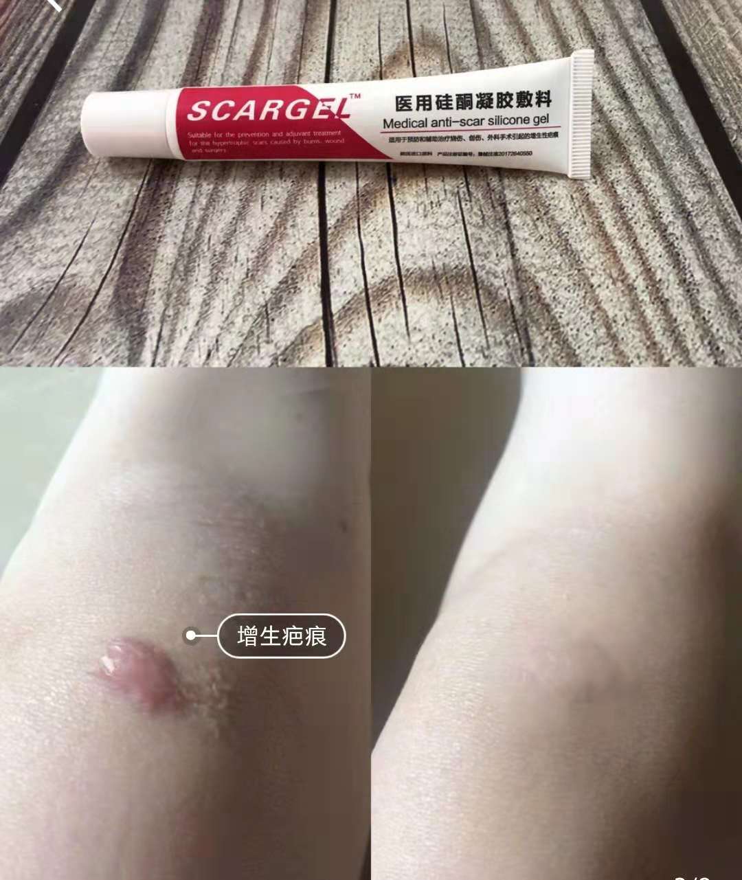 去妊娠纹修复测评推荐,去妊娠纹产后修复排行榜