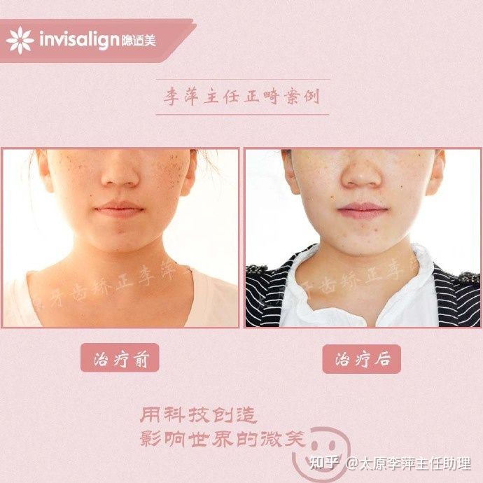 太原矫正牙齿需要做正颌吗,太原牙齿二次矫正