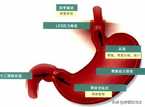 反流性食管炎用什么中药能治,反流性食管炎常用药