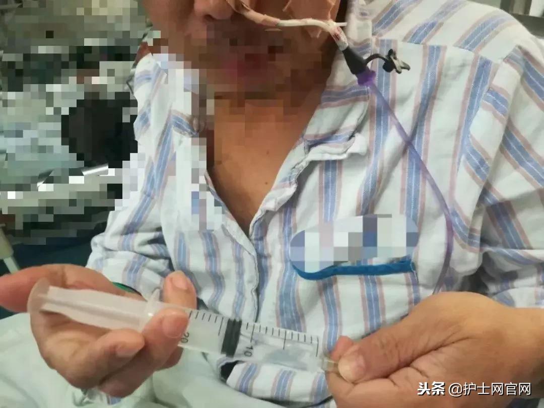 肠部手术后饮食护理,经鼻肠管进行肠内营养方法