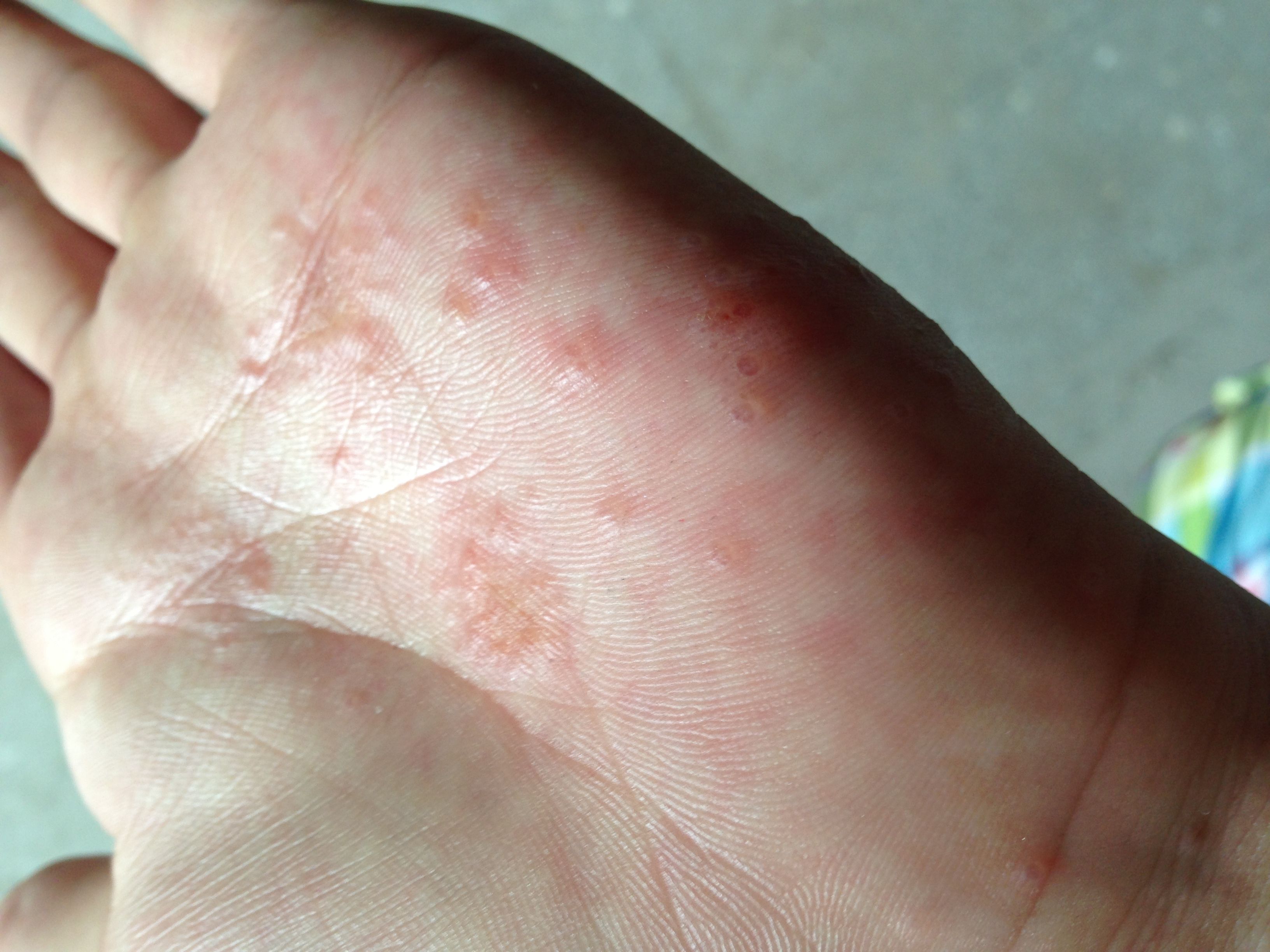 湿疹在中医里面是什么原因引起的,手掌湿疹反复开裂脱皮中医治疗