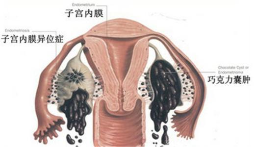 腺肌症+巧囊,这一路实在太难,后来才知道这俩可以一起解决