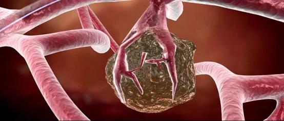 肿瘤饥饿疗法趣味视频,肿瘤饥饿疗法的优缺点