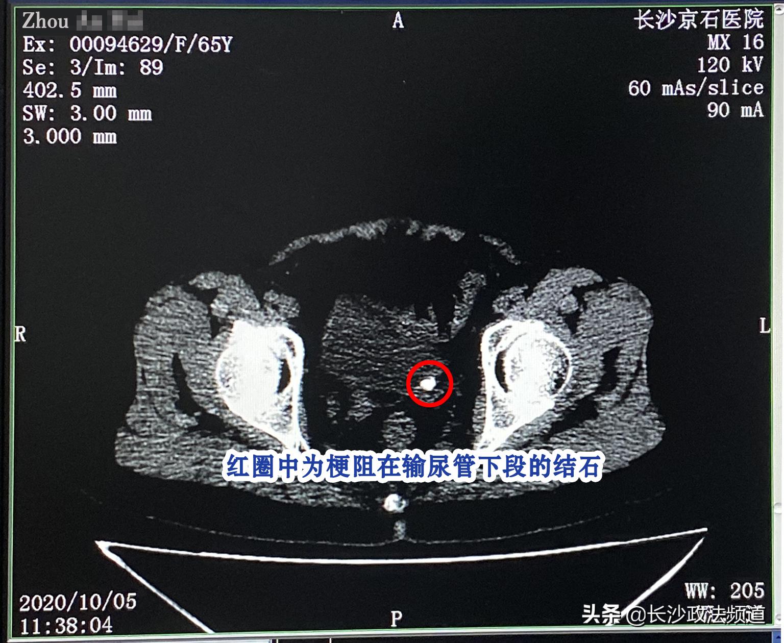 女性抗炎,女子炎症反复发作