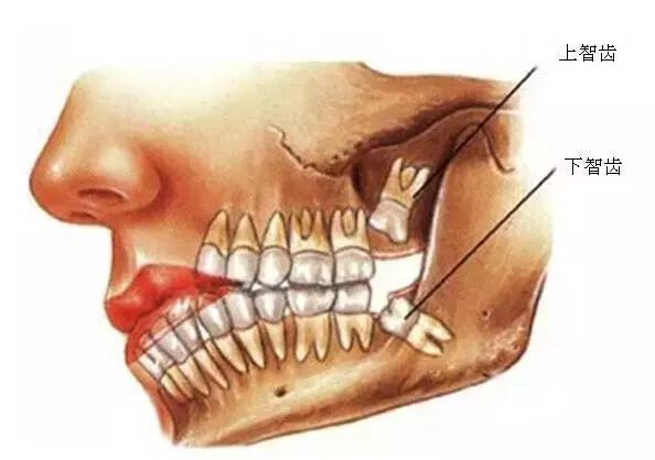 智齿倾斜拔不拔,智齿拔不拔多少钱